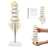 LYOU Life Size Lumbar Spine Model Lumbosacral Segment Model with A Herniated Disc 