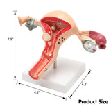 LYOU Life Size Human Uterus and Ovary Model Pathological Uterus Anatomical Model size