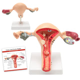 LYOU Life Size Human Uterus and Ovary Model Pathological Uterus Anatomical Model